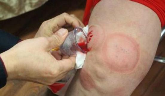 春节养生:膝盖积液过多不好治?可以使用这个方