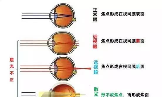 近视,远视,散光,宝宝表现各有不同,早发现,趁还来得及
