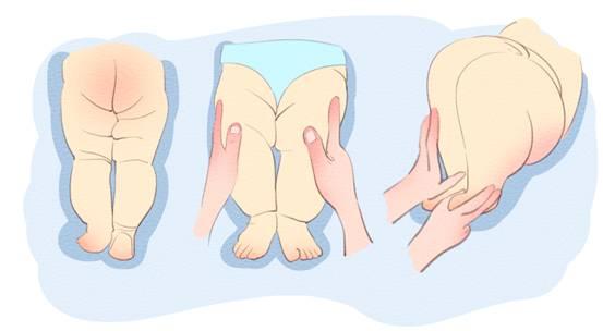 宝宝下肢的大腿纹和臀部纹不对称有问题吗