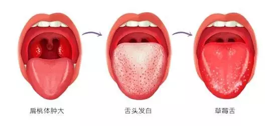 别把孩子发热、咽痛都当成是感冒,小心这个病