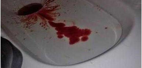 痔疮的症状?痔疮的危害?!