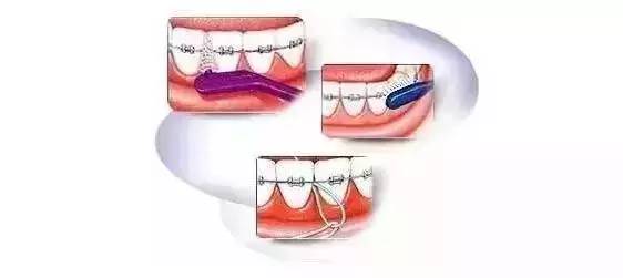 科普_正畸以后该怎么刷牙呢?