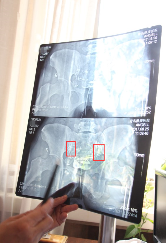 输卵管上举是啥意思,为什么会影响怀孕