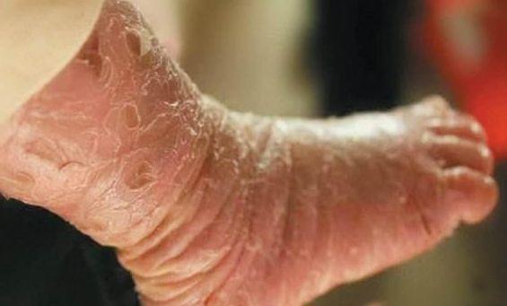 宝宝皮肤长着长着变成了鱼鳞