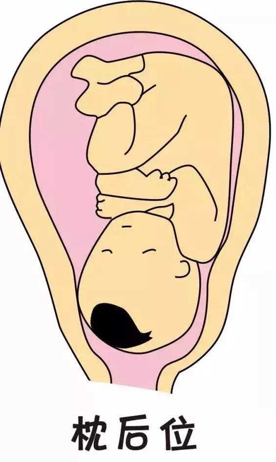 脸朝向孕妈腹部,这种胎位并不代表无法顺产,但可能会导致孕妈宫缩和