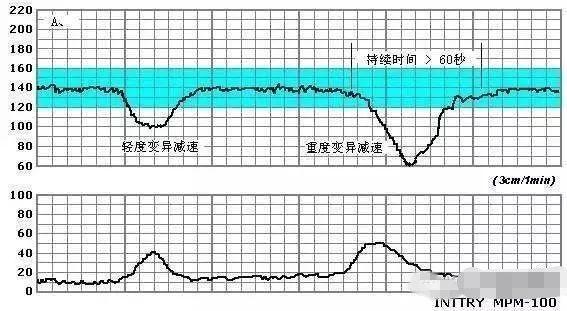 看不懂胎心监护图谱, 是不是等于白做了?