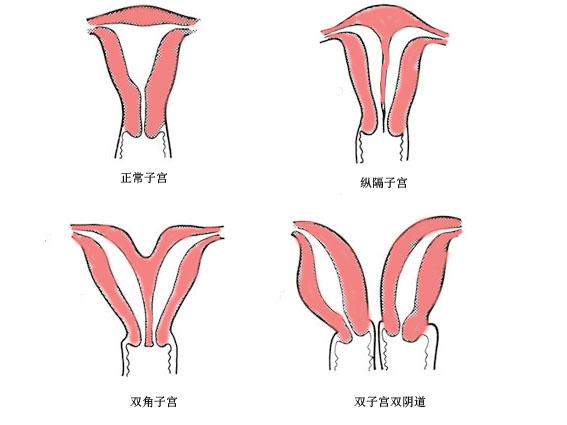 3,双角子宫:双角子宫的外观看起来像是个"心型"的子宫,有可能左右