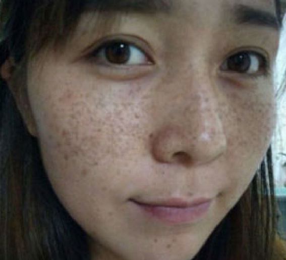 脸上长斑不要慌,巧用维e 生姜,仅需每晚敷下脸,7天淡
