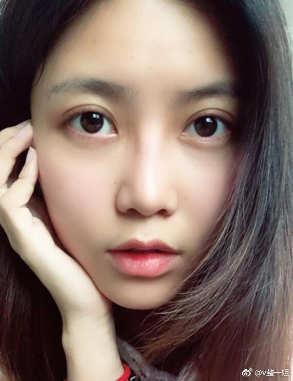 北京自体脂肪填充全脸案例分享,术前术后一个