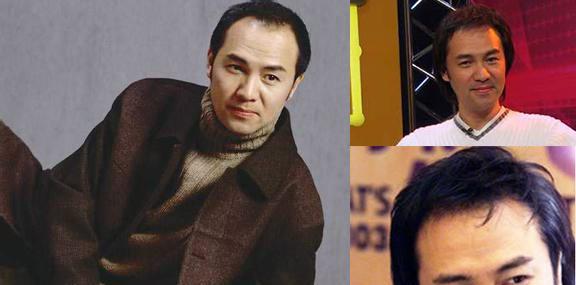 光头明星辣么多，他们为啥不植发？