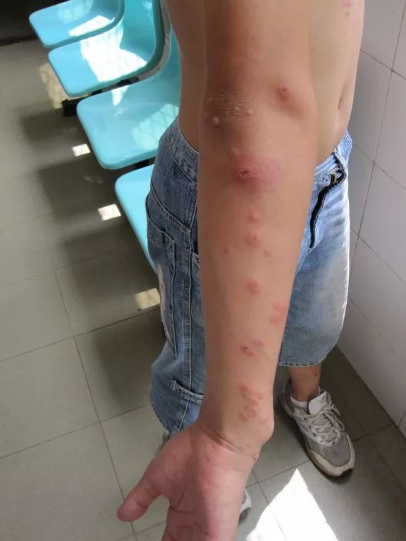 近日广东单纯疱疹高发