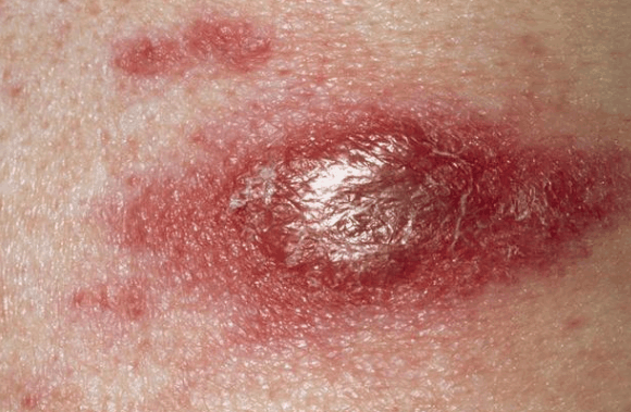 耳垂后面长了个硬包,摸着有点疼?要注意了