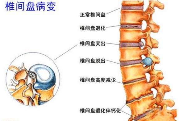 民间治病小偏方，一个绝招根除腰间盘突出，不看看就走就真的亏了