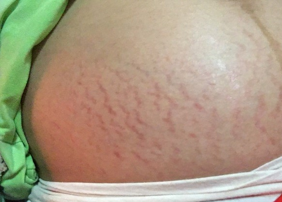 如何保养才能预防妊娠纹 孕期怎么减少妊娠纹