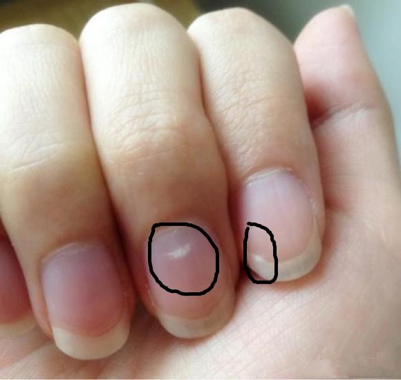 肚里有虫身体是什么表现?医生:不只是腹痛那么简单