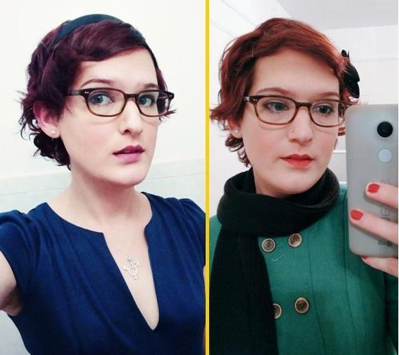 国外男子为治愈脱发, 服用了过量雌激素, 一年后变成了“大美女”