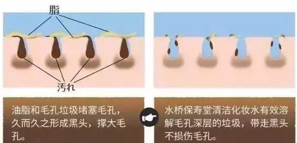黑头有救啦!水桥保寿堂去黑头喷雾还你一个白