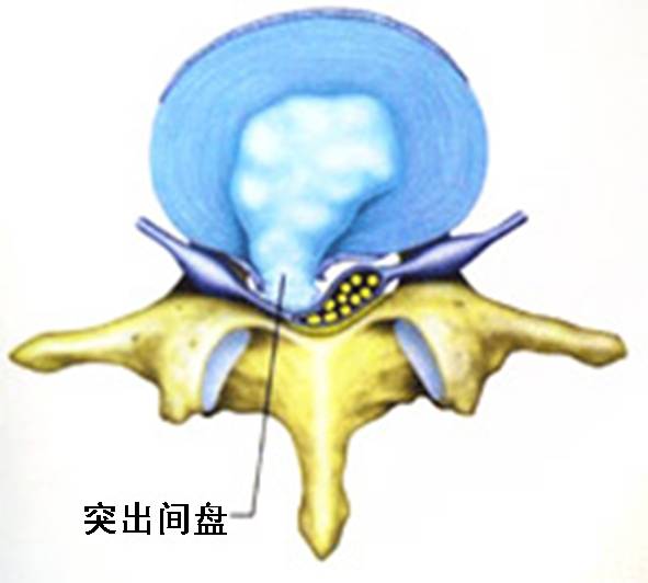 老祖宗留下的治腰疼方法，都嫌普通不用，我的腰间盘突出却好了