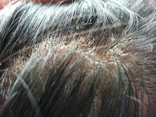 3招杀光头螨,发根变粗,头发厚一倍!