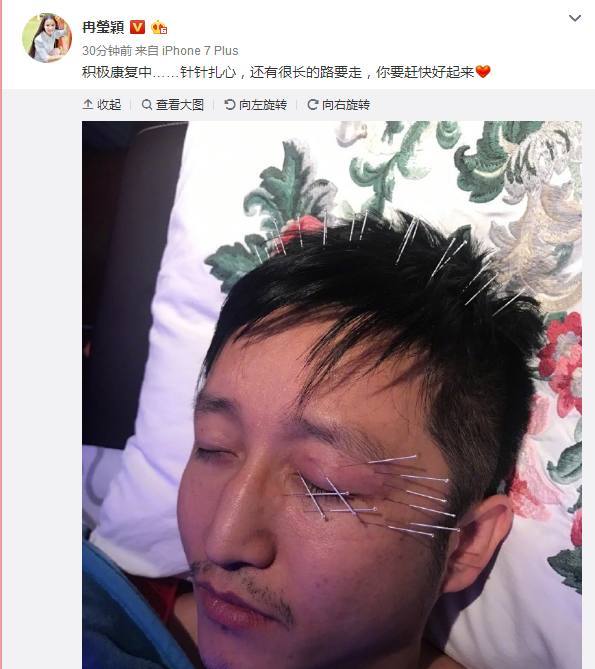 冉莹颖曝光邹市明针灸治疗 头部扎满银针看着就疼!