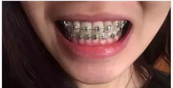 牙齿矫正|不就戴个牙套的事儿,牙齿矫正凭什么