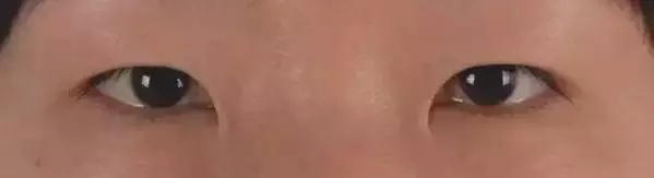 打死都不开眼角，然后我的双眼皮做成了这样~
