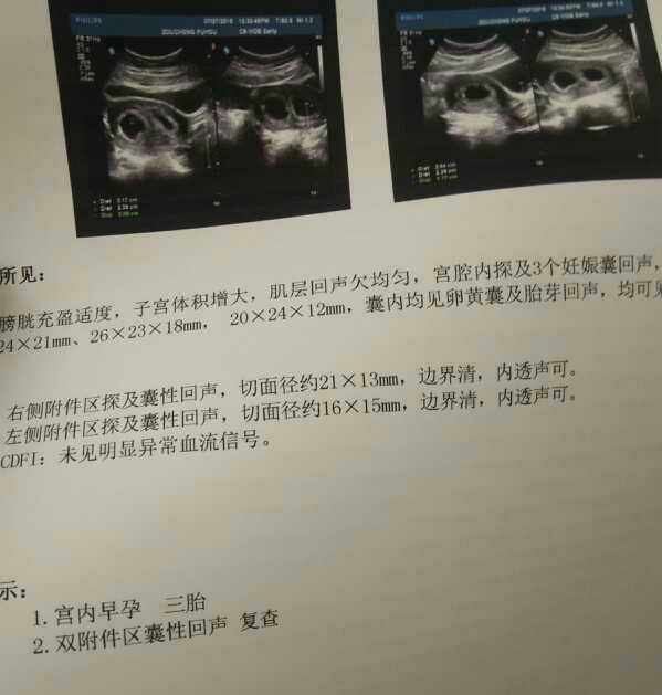 怀三胞胎,不听医生建议坚持孕检,胎儿出生就停止呼吸!