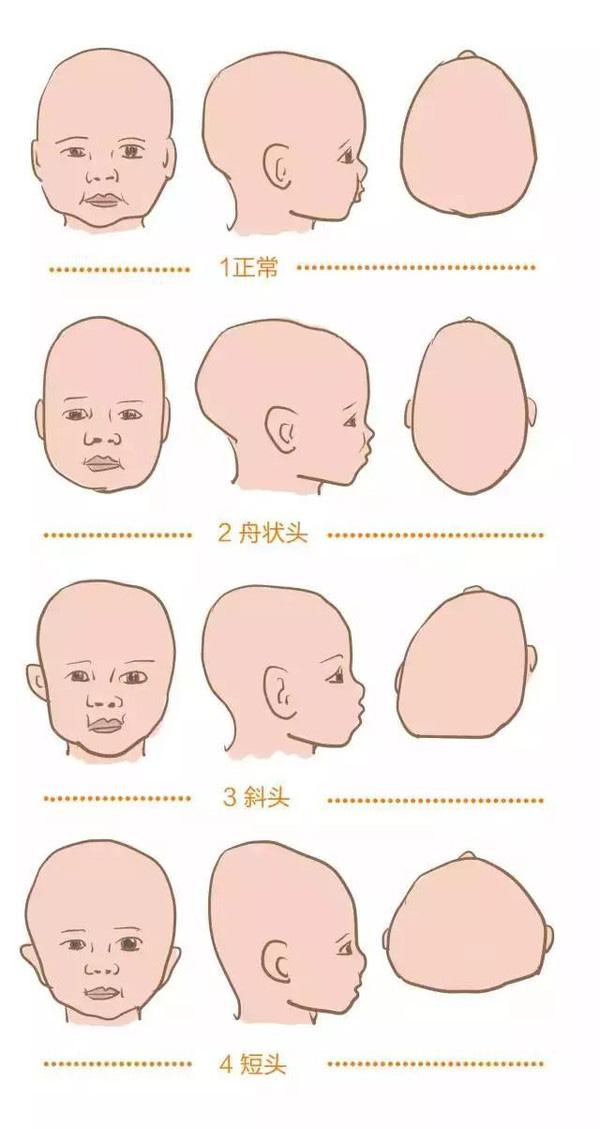正文   孩子头颅不对称,往往是由于早产,各种先天性因素,后期睡姿导致