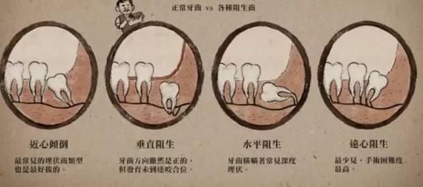 别困惑了,智齿有这些问题就快拔了吧