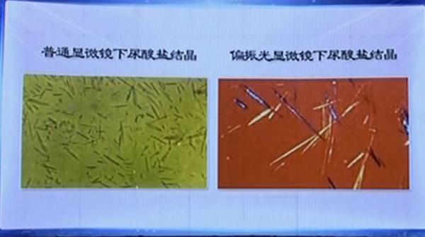 高尿酸降不下来？CCTV《健康之路》推荐的食疗方，尿酸高必学！