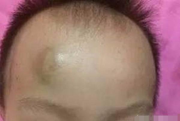 2岁宝宝头上摔个大包,非常经典的文章,不看后悔