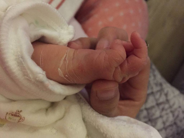 新生宝宝脱皮不用慌 这是宝宝的成长!