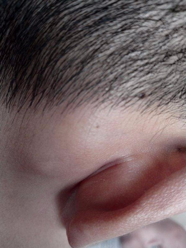 耳朵后长了个硬包是怎么回事?医生专家说:要当心这3种