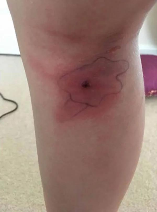 8岁女孩高烧不退,腿上伤口破裂跑出一只8脚蜘蛛!