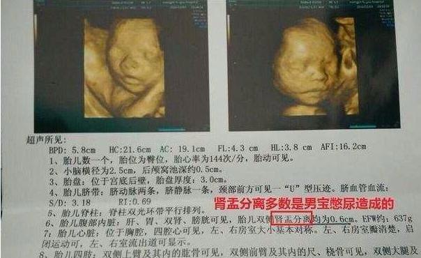 B超看这3个数据,能准确的判断胎儿的性别,准确