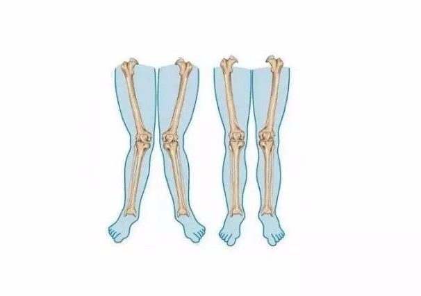 你不是梦露,X型腿不能让你变性感。