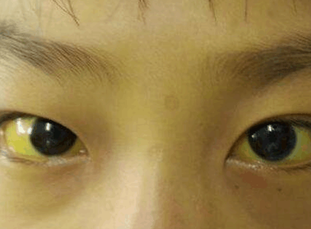 出现眼睛发黄,皮肤发黄,尿液发黄等症状,称为黄疸病例,也叫三黄症