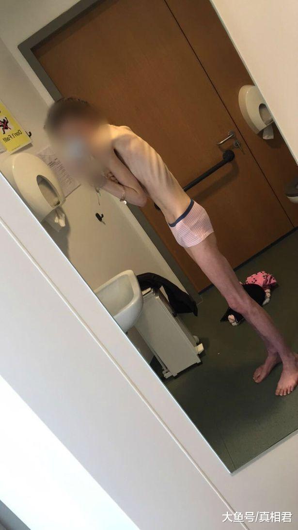 年轻的女厌食症患者体重只有25公斤! 正面临死亡危险!