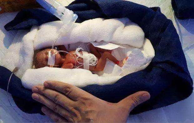 史上最小的生存者:印度宝宝出生时400克,6个月后模样