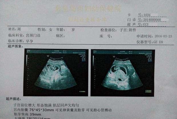 孕囊数据看性别 准确率80% 已验证