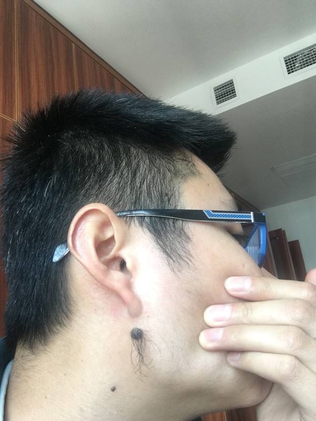 痣上长毛好不好,能不能去掉?
