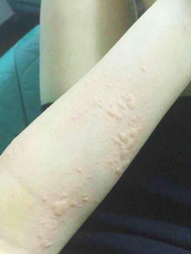 痒痒痒,见风起疙瘩!即日起,用上这个,荨麻疹不