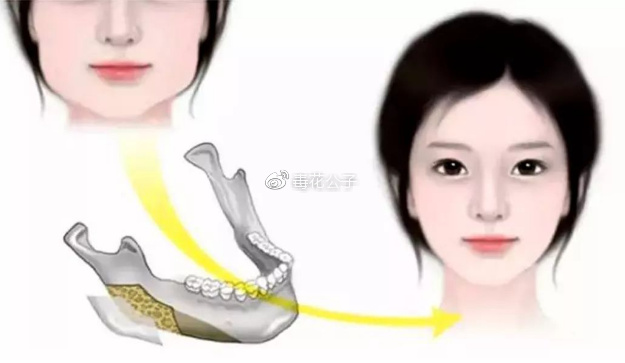 面部轮廓塑形,需要面部填充还是磨骨手术?