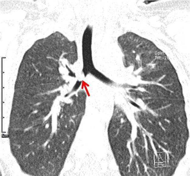 放射科诊断支气管异物的关键不是看图,而是家长的细心