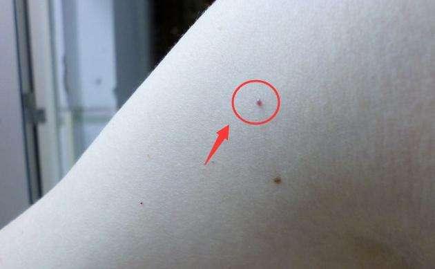 身上长了很多小红点,像小红痣,不痛不痒的是怎