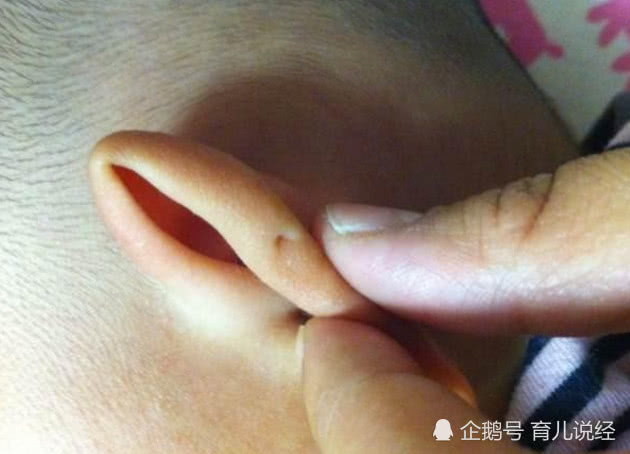 有些宝宝耳朵上长的这个小窝,家长们知不知道这是什么