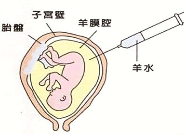 怀孕近五个月做羊水穿刺做完后半小时孩子就没了