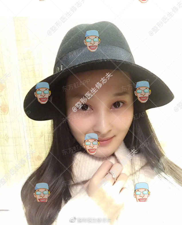 歪鼻修复术后40天恢复日记:从沮丧煎熬到欣喜