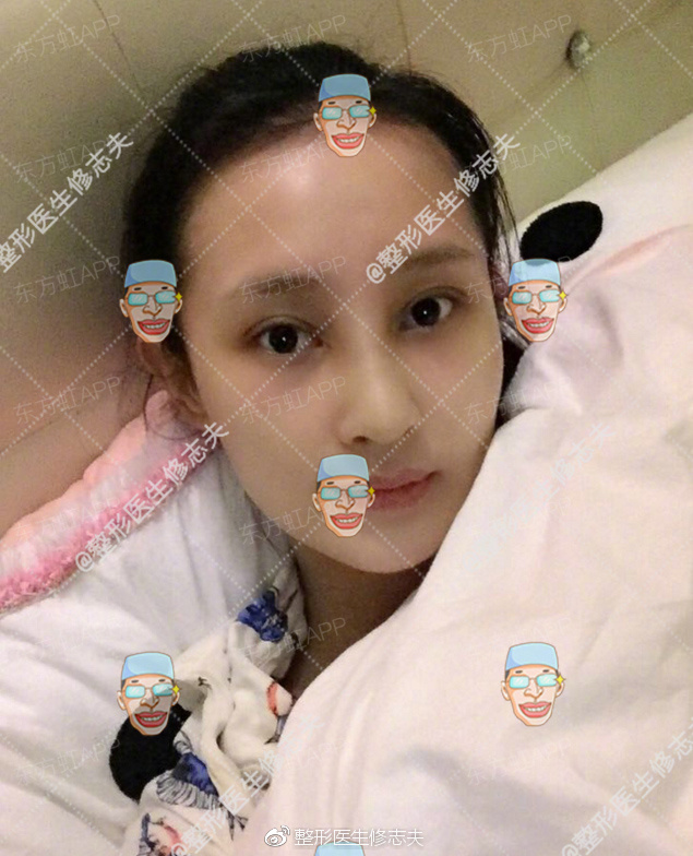 歪鼻修复术后40天恢复日记:从沮丧煎熬到欣喜