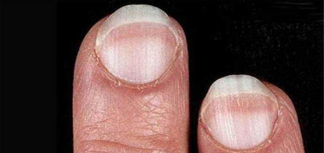 癌症信号就在指甲上,7种疾病风险全部显示在指